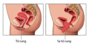 Phẫu thuật nội soi phục hồi nhanh sa niệu – sinh dục với mảnh ghép đặc biệt