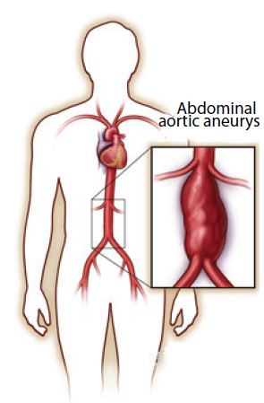 how to detect thoracic aortic aneurysm