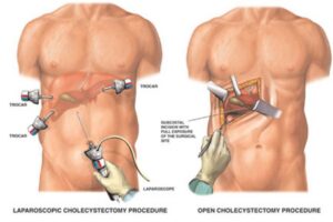 Cholecystectomy