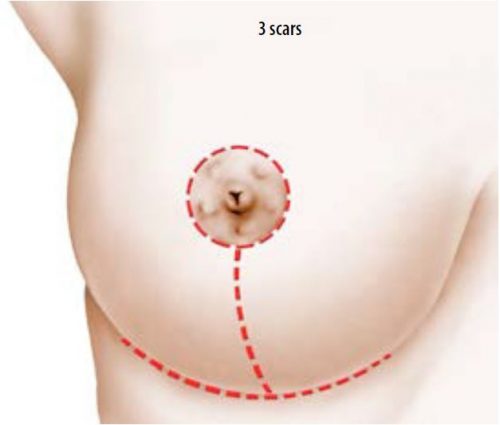 Phẫu thuật thu nhỏ ngực hoặc tạo hình ngực thẩm mỹ - Bệnh Viện FV
