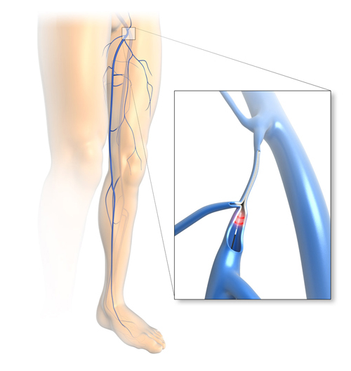 Laser combined with the Muller procedure to treat varicose 