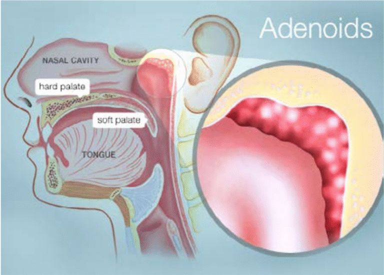 Adenoids And Adenoid Removal