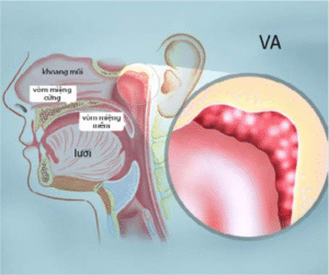 Va Và Phẫu Thuật Nạo Va