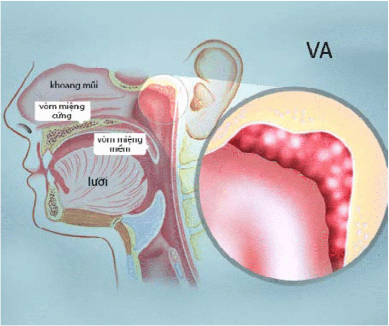 Va Và Phẫu Thuật Nạo Va