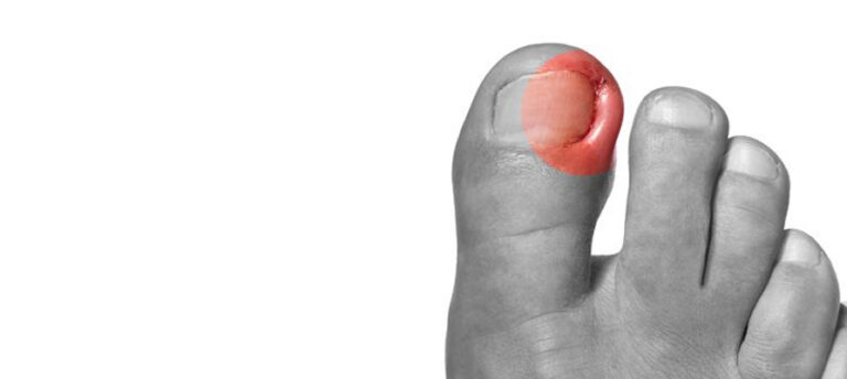 Ingrown Toenail