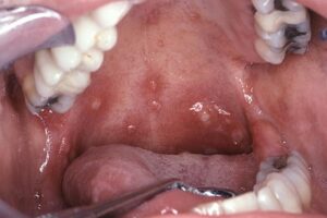 Hand, Foot And Mouth Disease