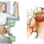 Bone Marrow Aspiration And Biopsy