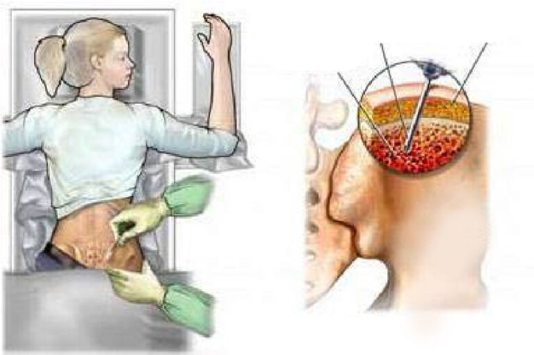 Bone Marrow Aspiration And Biopsy