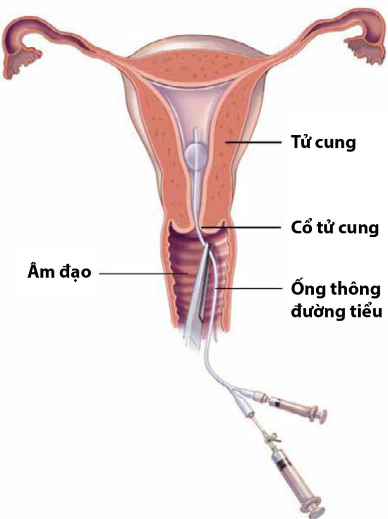 Chụp X-Quang tử cung và vòi trứng