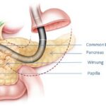 Endoscopic retrograde cholangiopancreatography (ERCP)