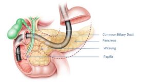 Nội Soi Mật Tụy Ngược Dòng (ERCP)