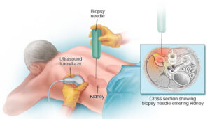 Percutaneaous kidney biopsy under image guidance