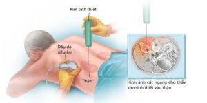 Sinh thiết thận qua da dưới hướng dẫn của hình ảnh