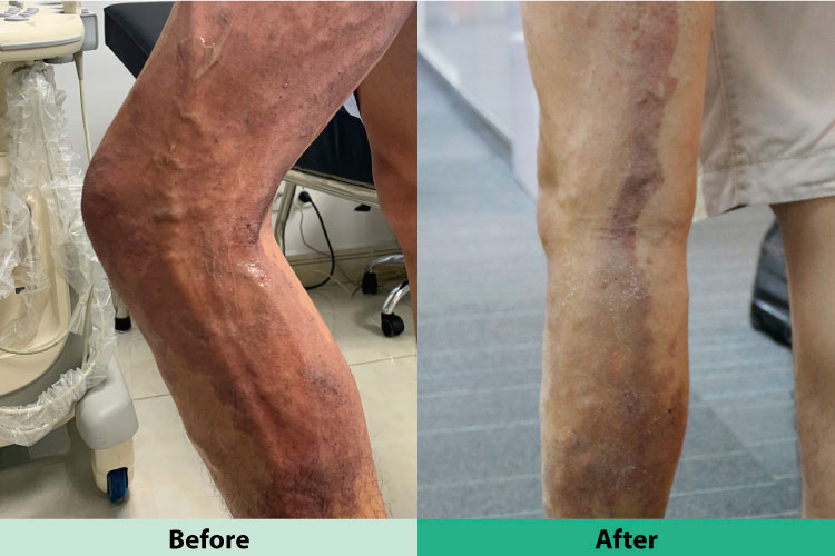(PDF) Potential Risk Factors for Varicose Veins with 