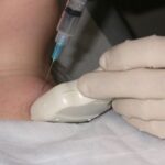 Fine Needle Aspiration for Head and Neck Conditions