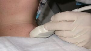 Fine Needle Aspiration for Head and Neck Conditions