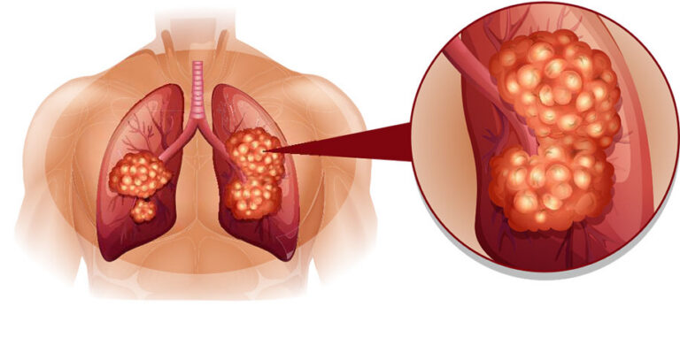 Low Dose CT Lung Cancer Screening