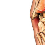 Pilon fracture