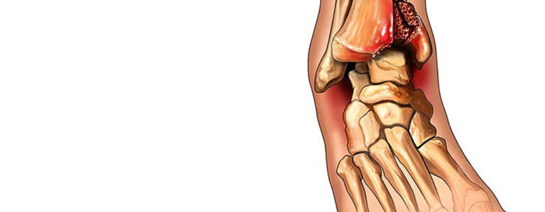 Pilon fracture