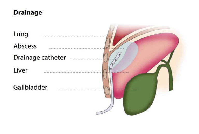 Percutaneous Abscess Drainage