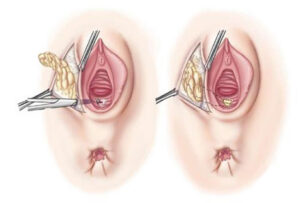 After many years of failed treatment for rectovaginal fistules, patient recovers thanks to FV’s unique approach