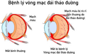 Tránh biến chứng Mù lòa do Bệnh lý Võng mạc ở Bệnh nhân đái tháo đường