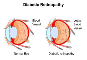 Prevent vision loss for Diabetic patients
