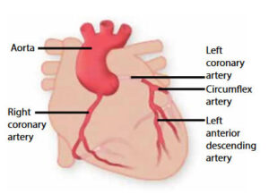 Coronary Angiogram and Angioplasty (Percutaneous Coronary Intervention)