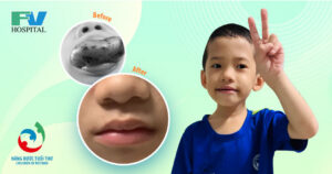 Normal Life Given To Child With Lymphangioma