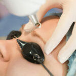 Laser tattoo removal