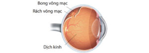 Bong Võng Mạc