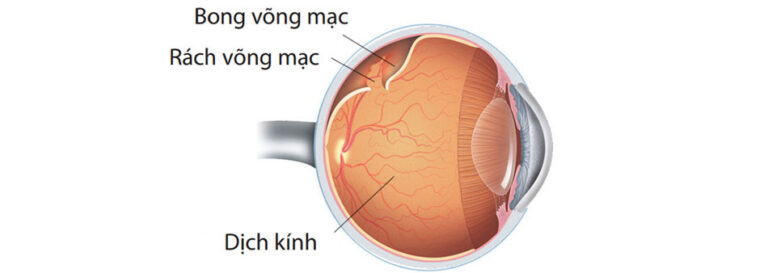 Bong Võng Mạc
