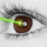 What is LASIK eye surgery?
