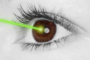Phẫu thuật LASIK tại mắt là gì?