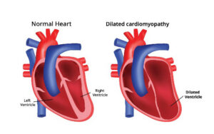 Prevent The Risk Of Heart Failure Due To Dilated Cardiomyopathy