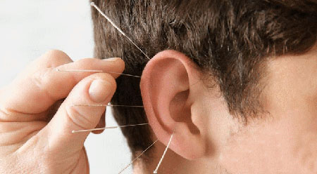 Ear Acupuncture Method