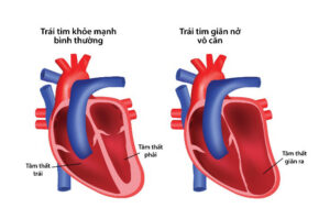 Nguy Cơ Suy Tim Từ Bệnh Lý Cơ Tim Giãn Nở Vô Căn