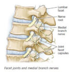 Facet Joint Injections for the Treatment of Pain