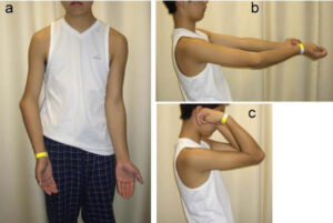 Convex fracture of the arm bones: a type of fracture common in children and which can easily cause complications