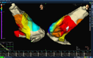 Premature ventricular contractions are treated successfully via Ablation after many years of medication