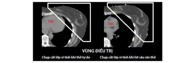 Kỹ Thuật Hít Sâu Nín Thở và Thiết Bị Điều Phối Nhịp Thở Chủ Động