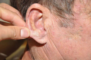 FV provides surgical treatment and reconstruction for an ear canal melanoma for an elderly American patient