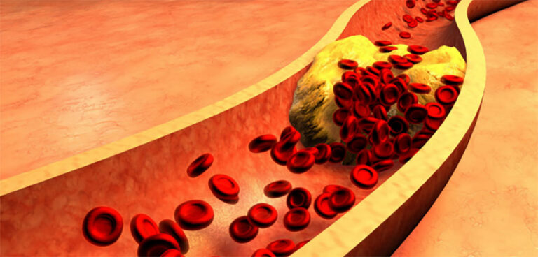 Tổng Quan Về Cholesterol (Mỡ Trong Máu)
