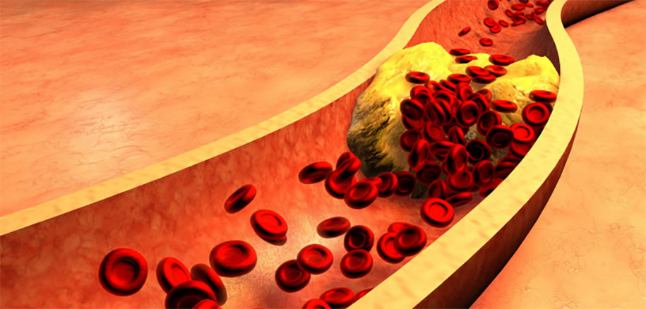 Tổng Quan Về Cholesterol (Mỡ Trong Máu) - Bệnh Viện FV
