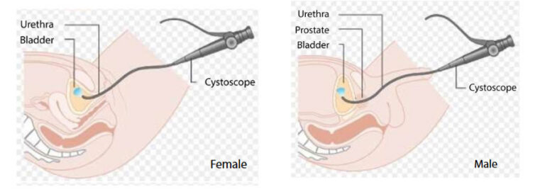 Cystoscopy