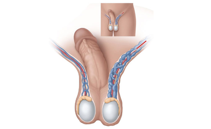 Varicocele Information  Mount Sinai - New York