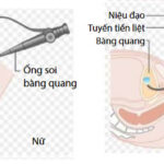 Nội soi bàng quang