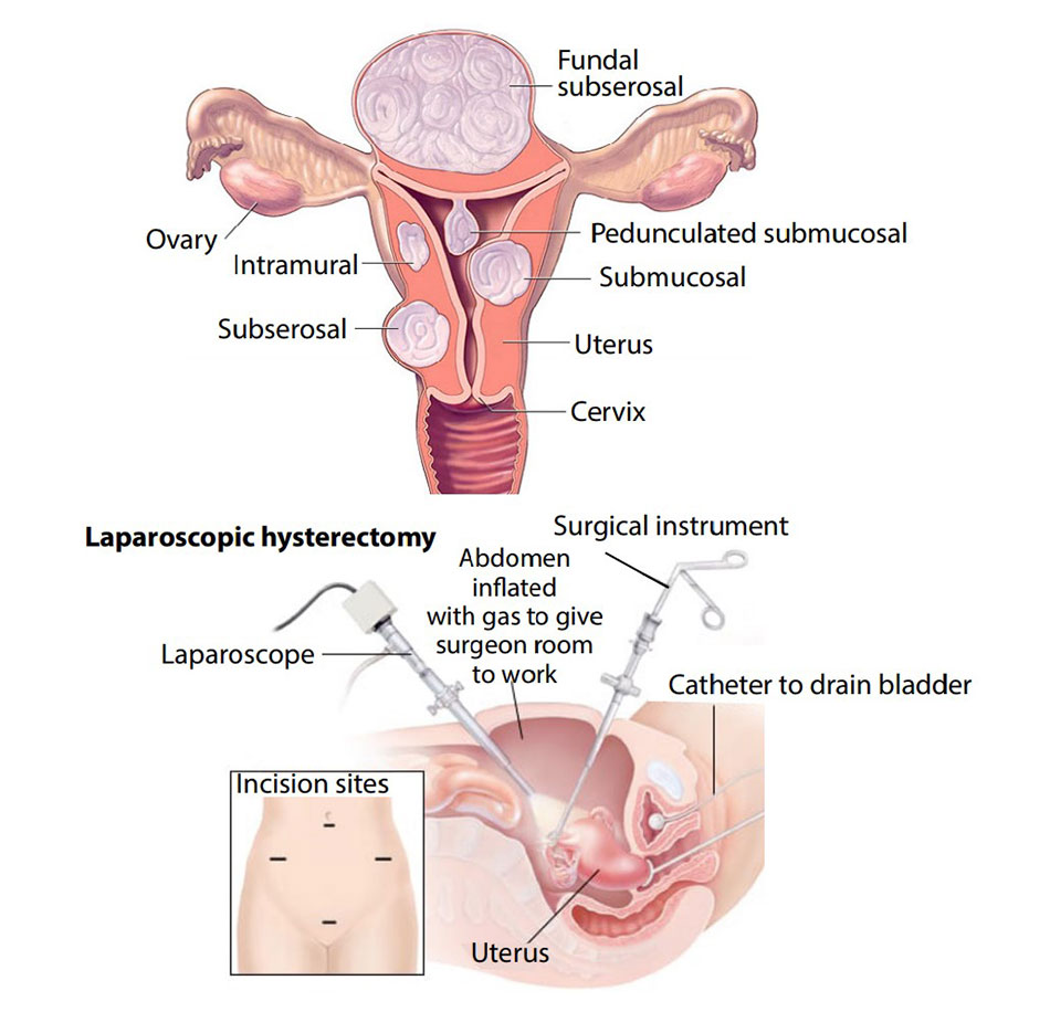 laparoscopic hysterectomy before and after