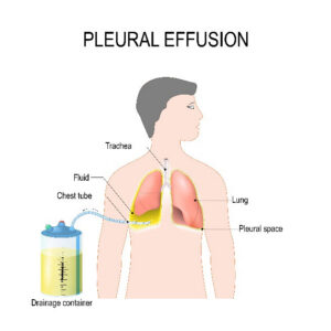 Treatment for the Recurrence of Pleural Effusion in Cancer Patients