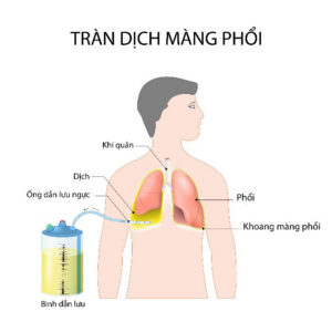 Điều trị Tràn Dịch Màng Phổi Tái Phát cho Bệnh nhân ung thư